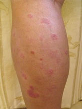 psoriasis before